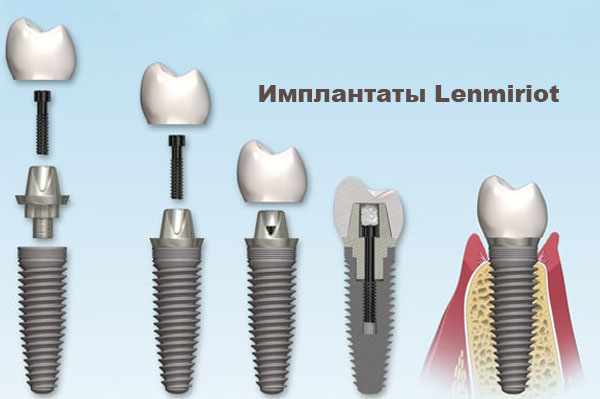 ustanovka implant lenmiriot