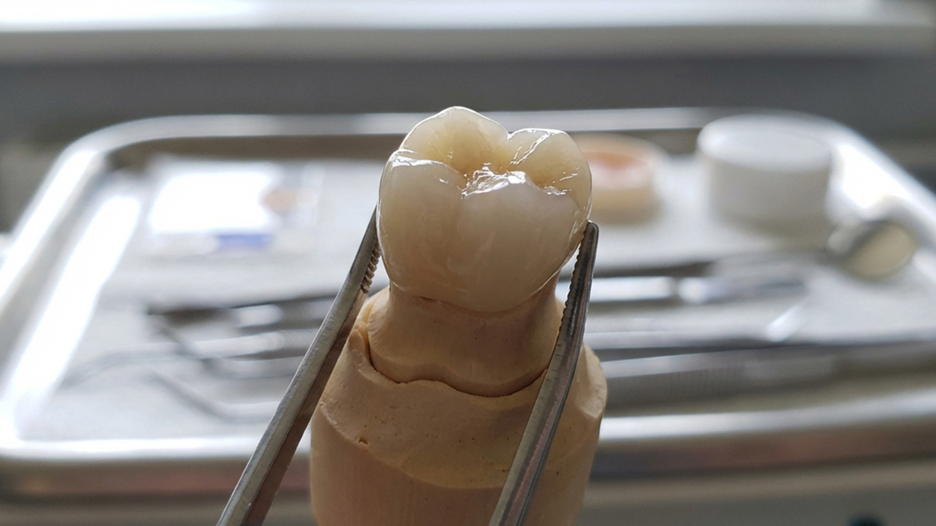 kista zuba prichiny simptomy i metody lecheniya 02