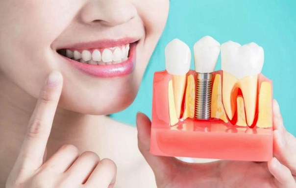 implantatchia zubov