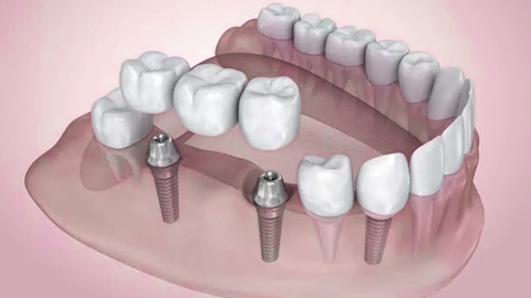 kak stavyat implant zuba etapy implantacii 2