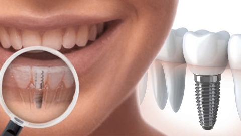 kak stavyat implant zuba etapy implantacii 3