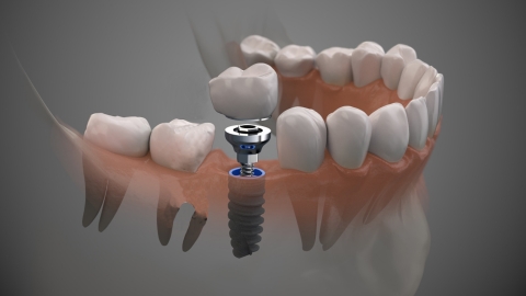 kak stavyat implant zuba etapy implantacii 4