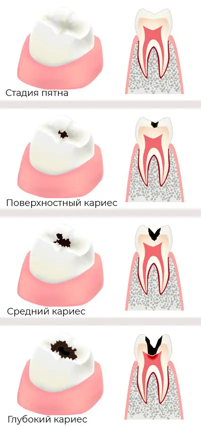 Начальный и поверхностный кариес: симптомы и методы лечения