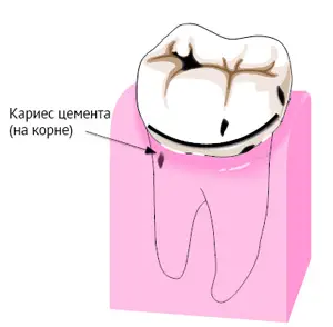 Тактика врача при наличии кариеса корня