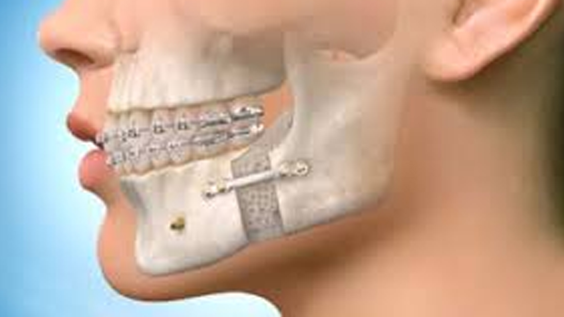 kostnaya plastika chto eto i kogda ona nuzhna pered implantacziej 01