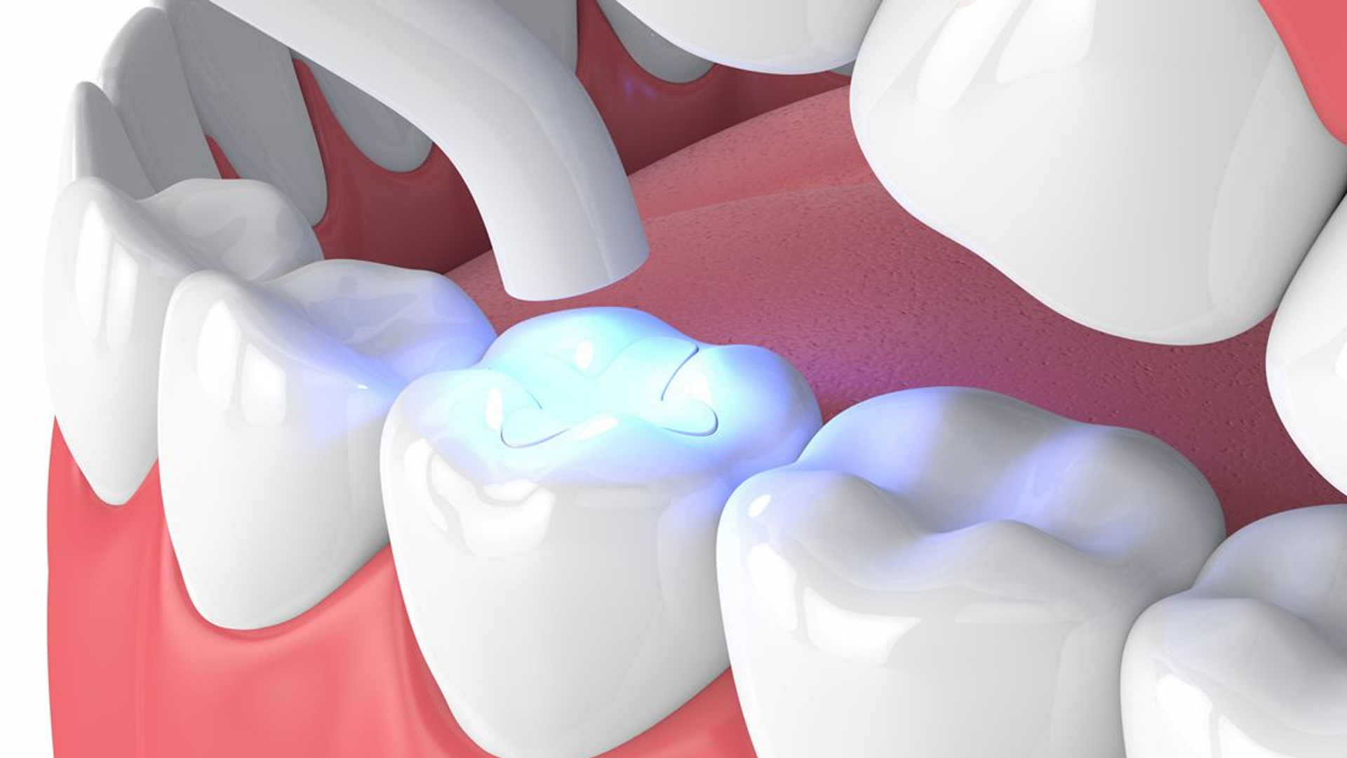 ot chego na samom dele zavisit srok sluzhby plomby 01