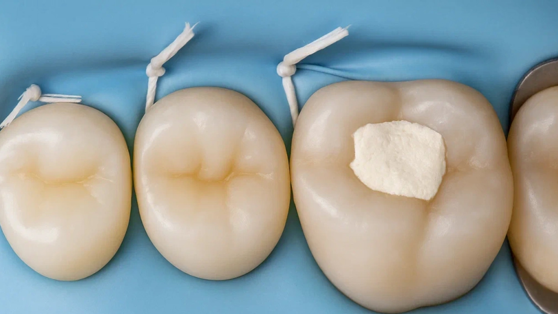 ot chego na samom dele zavisit srok sluzhby plomby 02