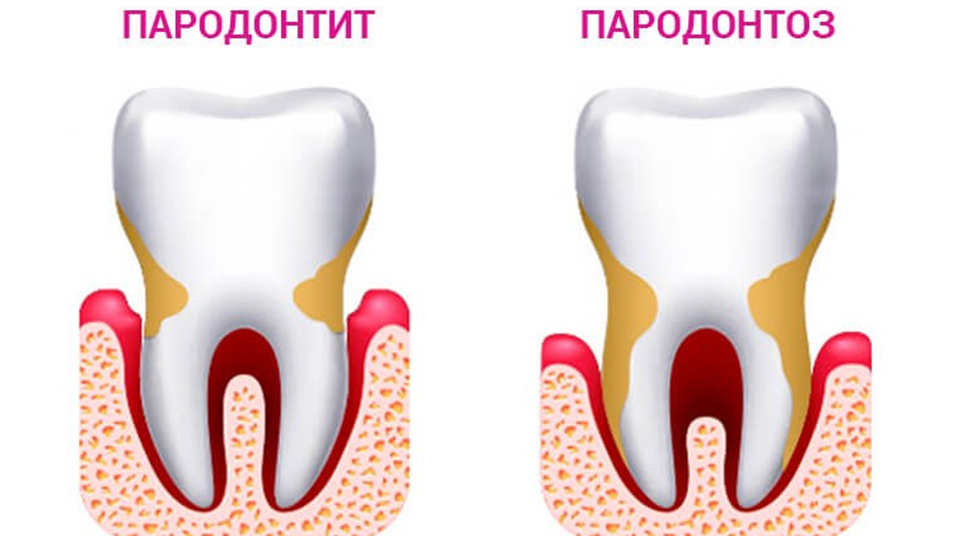 parodontit desen simptomy i lechenie 03