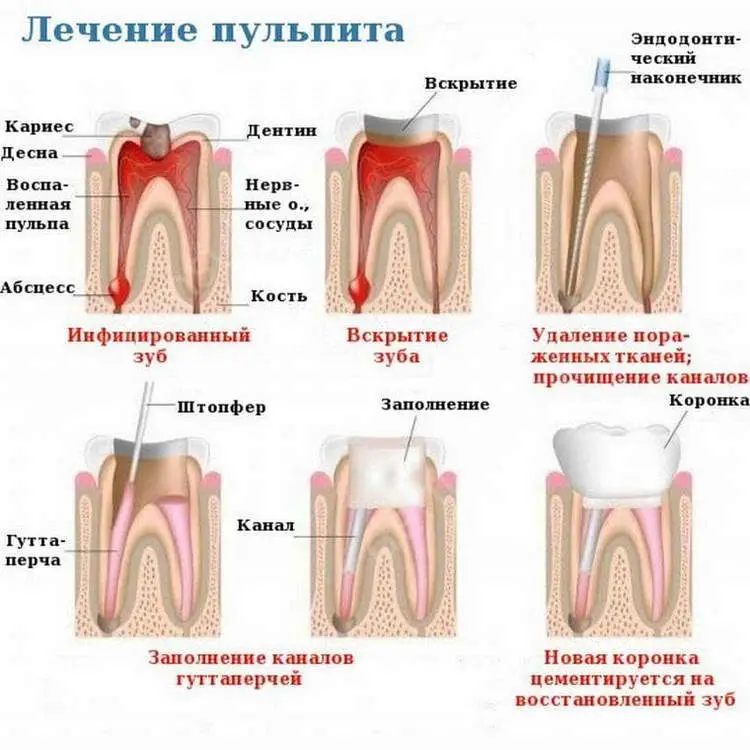 Методы лечения пульпита