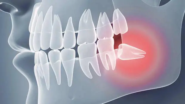 procedura udaleniya zuba bolno ili strashno 3